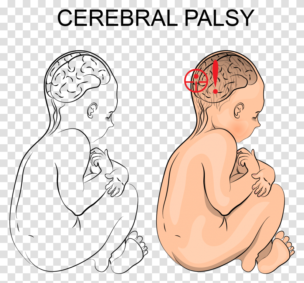 How Can I Tell If My Child Has Cerebral Palsy Cerebral Palsy Illustration, Person, Human, Kneeling Transparent Png