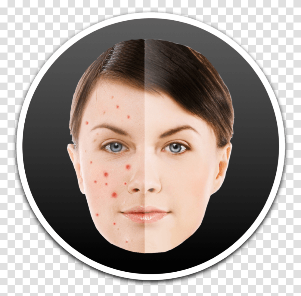 How To Remove Pimples And Blemish From Photos On Mac Acne, Face, Person, Human, Head Transparent Png