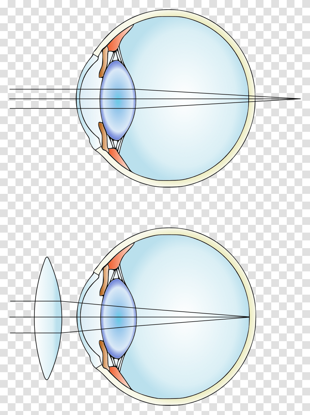 Hypermetropia And Correction Convex Lens Uses, Sphere, Magnifying, Sunglasses, Accessories Transparent Png