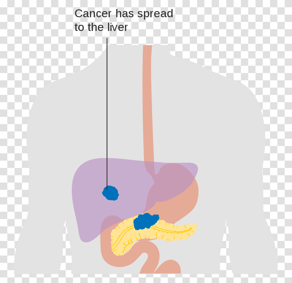 Illustration Pancreatic Cancer, Plot, Diagram, Back, Shoulder Transparent Png