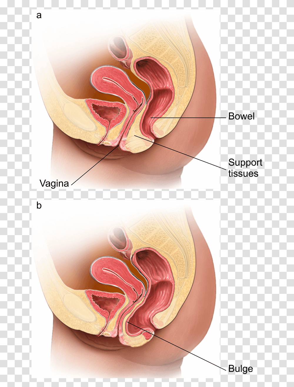Illustration Showing A Normal Vagina And One With A Posterior Prolapse, Skin, Neck, Ear, Collage Transparent Png