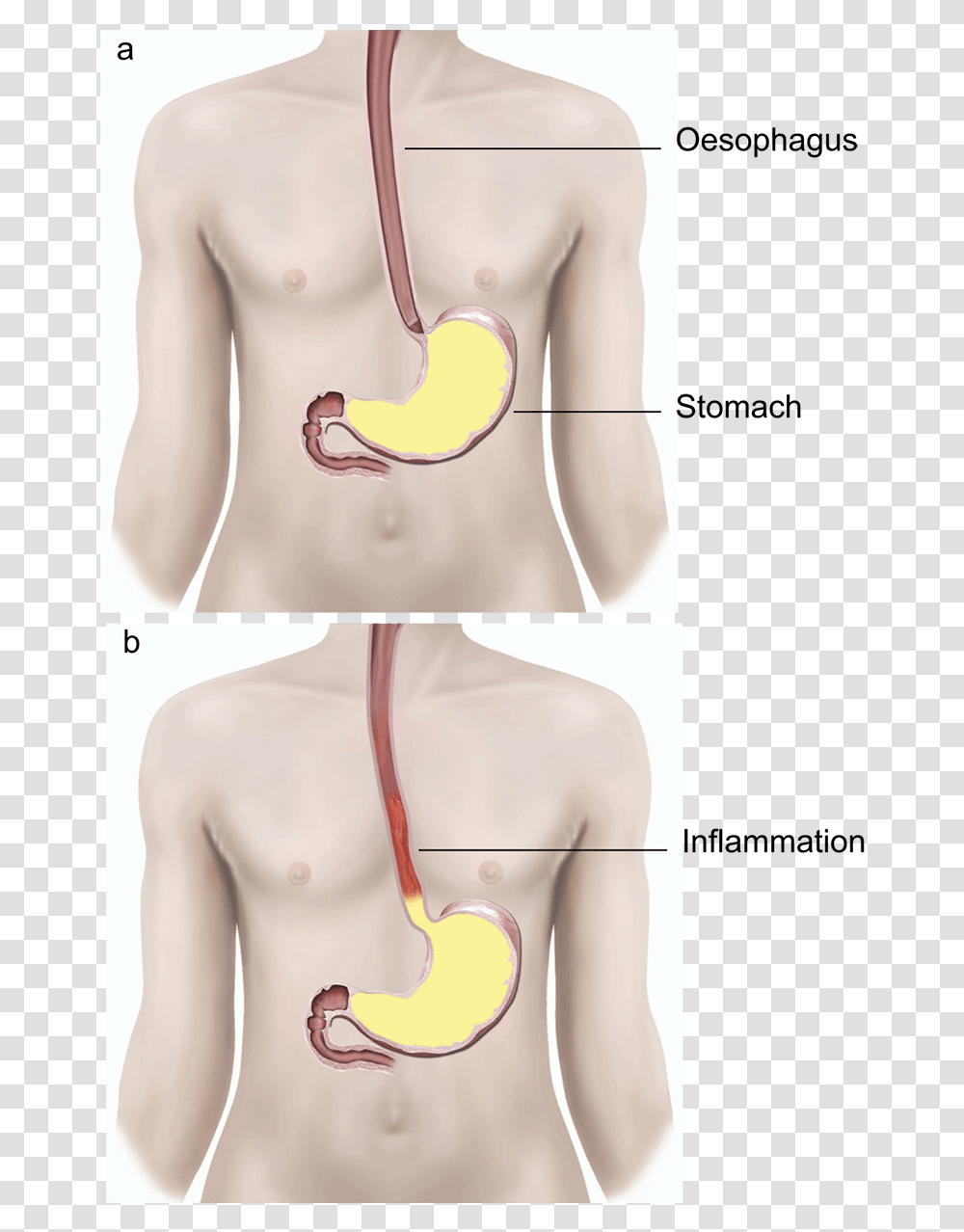 Illustration Showing A Normal Valve And A Faulty Valve Gerd Surgery Scar, Shoulder, Plot, Diagram, Stomach Transparent Png