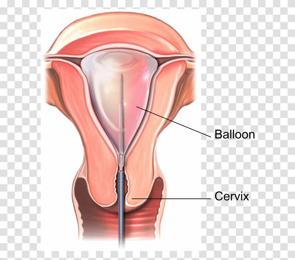 Illustration Showing A Thermal Balloon Endometrial Uterine Ablation, Hourglass, Helmet, Apparel Transparent Png