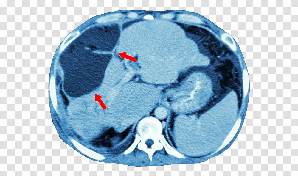 Imaging Liver Cancer Ct Scan, X-Ray, Medical Imaging X-Ray Film, Rug Transparent Png