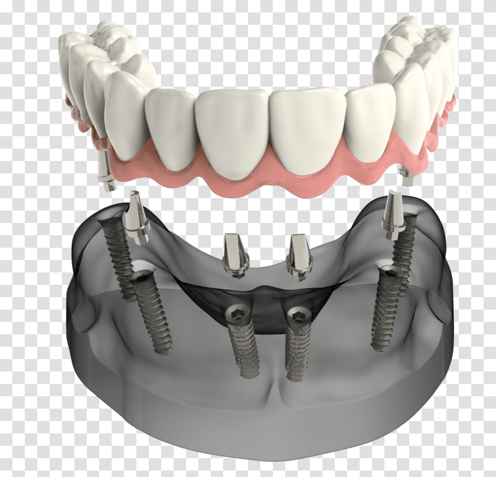 Implant Secured Denture Sudbury Ma Dentist, Teeth, Mouth, Lip, Jaw Transparent Png