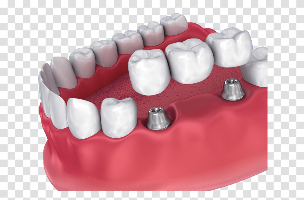 Implant Supported Bridge Dental Crown, Teeth, Mouth, Lip, Jaw Transparent Png