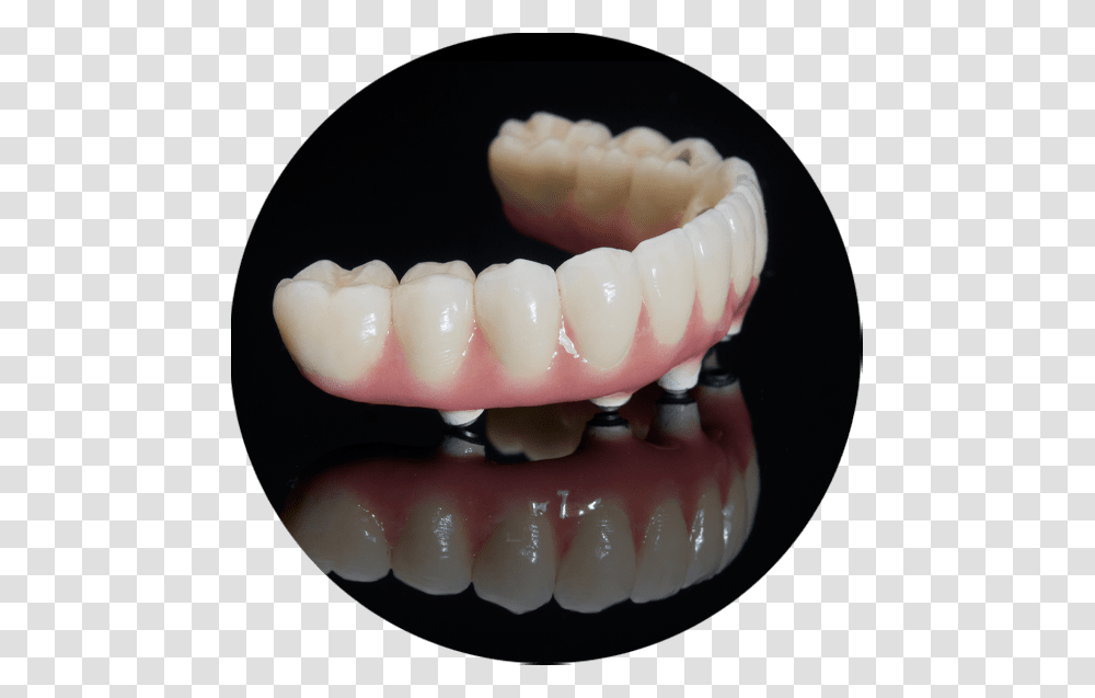 Implant Supported Bridge Full Arch Dental Implants, Teeth, Mouth, Lip, Jaw Transparent Png