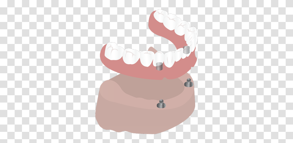 Implant Supported Dentures, Teeth, Mouth, Lip, Birthday Cake Transparent Png