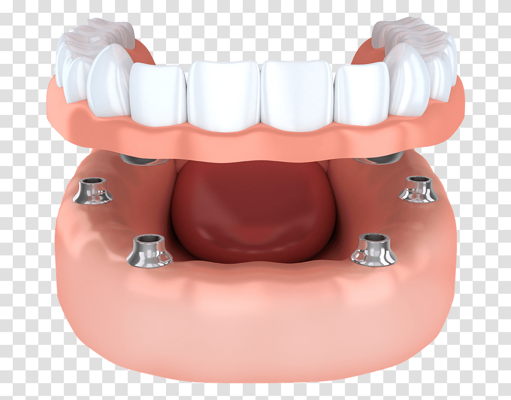 Implant Supported Model Brownstown Mi Snap Dentures, Teeth, Mouth, Lip, Jaw Transparent Png