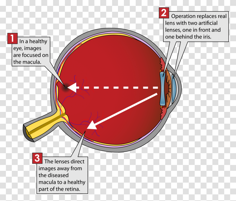 Implantable Miniature Telescope Diagram, Label, Sunglasses, Accessories Transparent Png