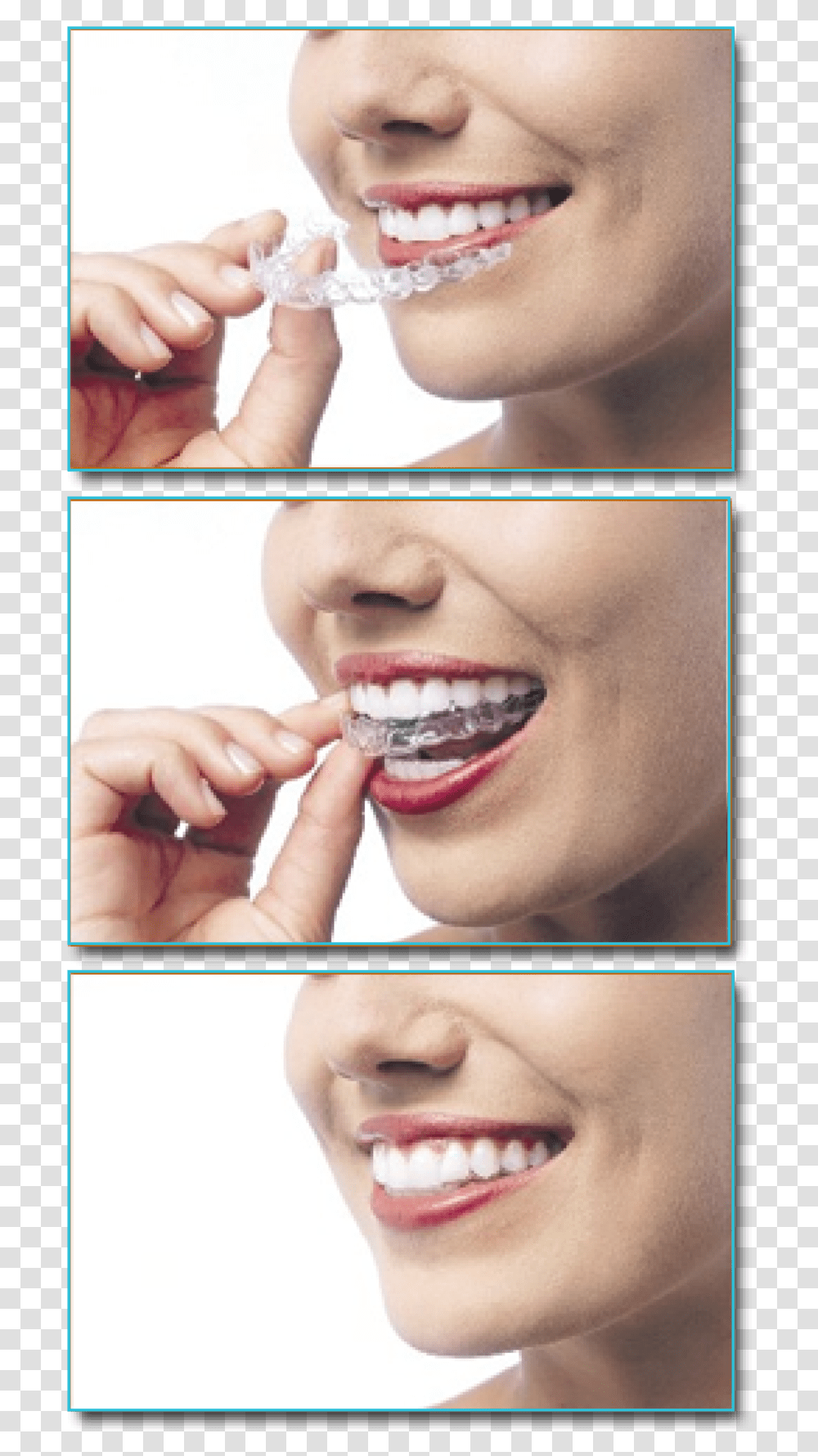 Invisalign Someone With Clear Aligners, Jaw, Teeth, Mouth, Lip Transparent Png