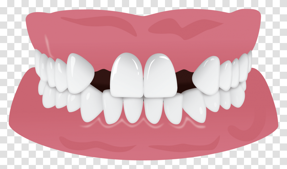 Ipr Black Triangles Results, Teeth, Mouth, Lip, Birthday Cake Transparent Png