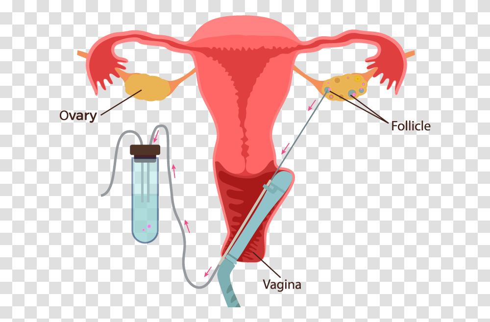 Ivf Process Step By Step Ivf Egg Collection Process, Bomb, Weapon, Weaponry, Teeth Transparent Png