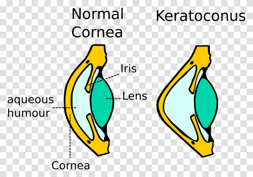 Kerataconus Image Diagram Of Keratoconus, Animal, Plant Transparent Png