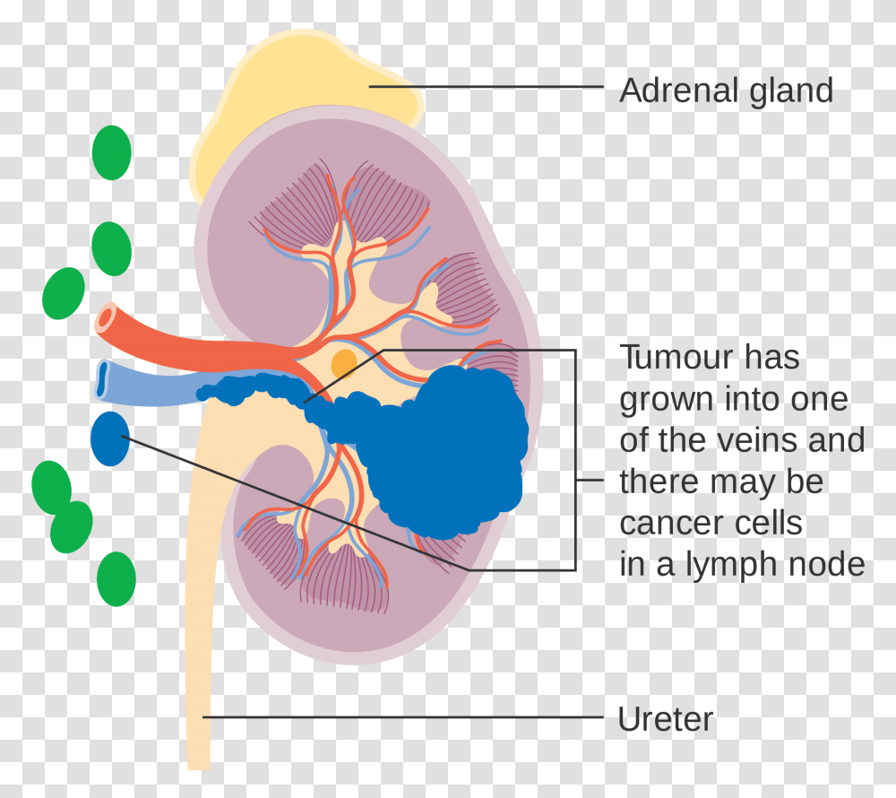 Kidney Cancer Surgery Kidney Cancer Stage Symptom, Plot, Diagram, Astronomy, Outer Space Transparent Png