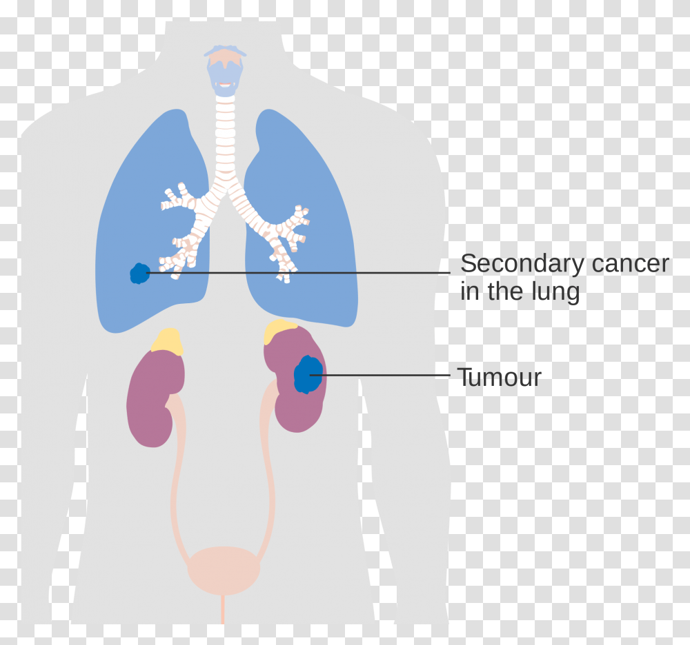 Kidneys Download Secondary Lung Tumor Transparent Png