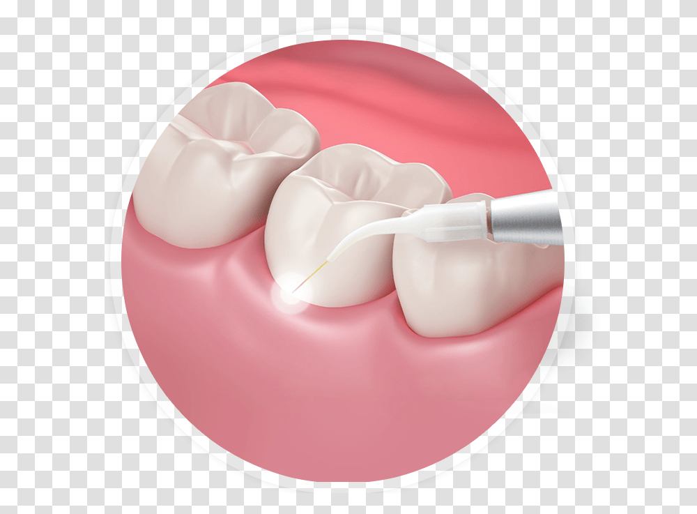 Laser Mouth Gums, Teeth, Lip Transparent Png