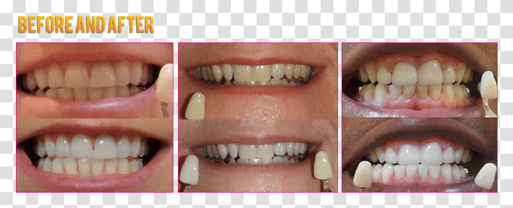 Led Teeth Whitening Coupons Led Teeth Whitening Before Colorfulness, Mouth, Lip, Person, Human Transparent Png