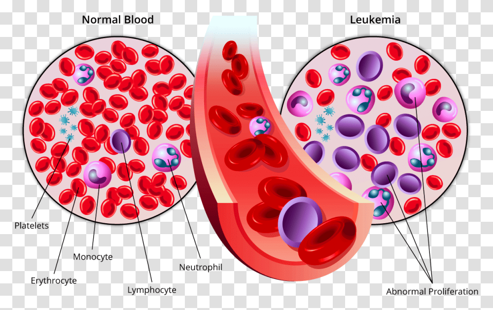 Leukemia Therapeutics Market Acute Myeloid Leukemia Blood Cancer, Plant, Fruit, Food, Watermelon Transparent Png