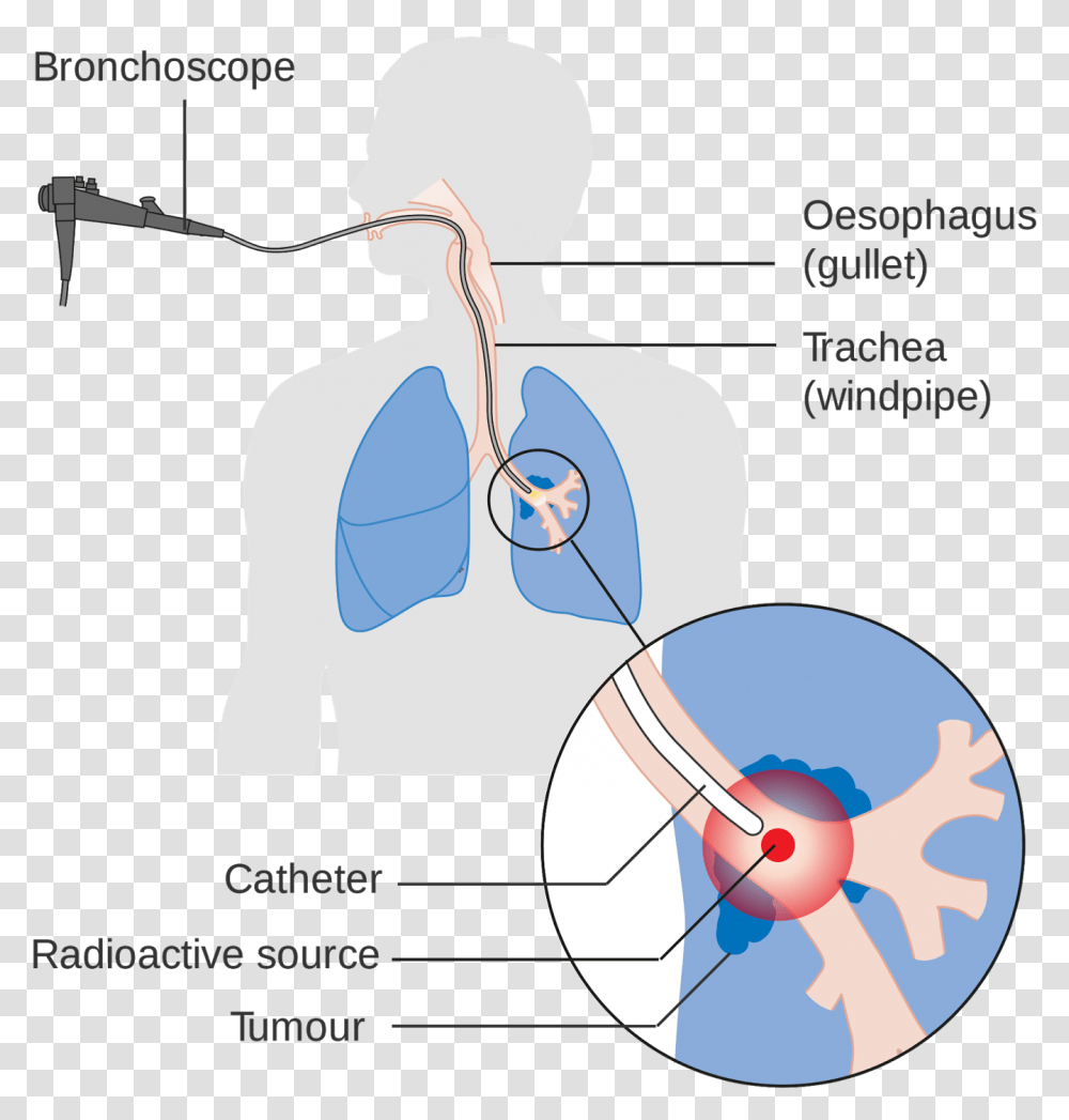 Lung Cancer Is The Leading Cause Of Death Due To Cancer, Injection, Neck, Diagram, Hip Transparent Png