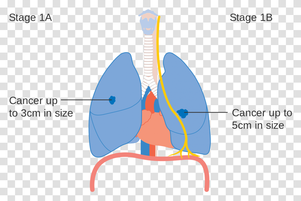 Lung Cancer Stages Diagram, Leisure Activities, Plot, Mandolin, Musical Instrument Transparent Png