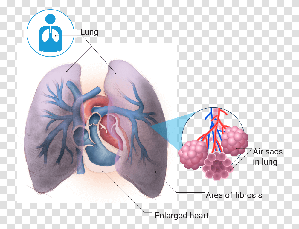 Lung Pulmonary Hypertension, Plant, Fruit, Food Transparent Png