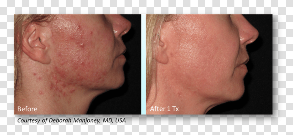 Manjoney Infini Acne Scars Before And After, Face, Person, Human, Jaw Transparent Png