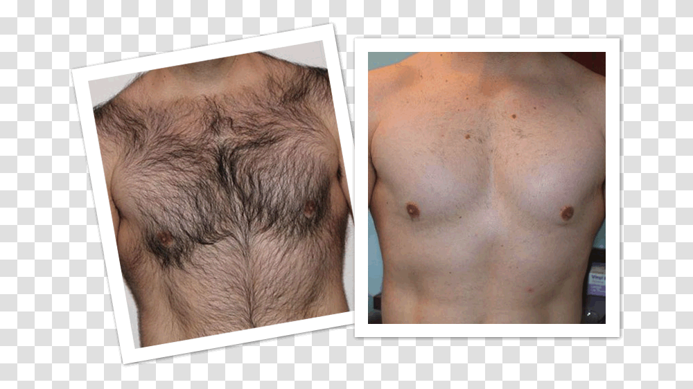 Mens Laser Hair Removal Before And After, Face, Person, Human, Collage Transparent Png