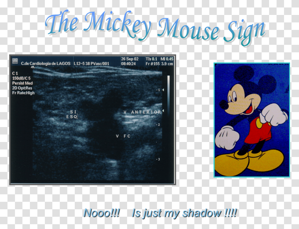 Mickey Mouse Symbol Mickey Mouse Sign Doppler, Astronomy, Outer Space, Outdoors Transparent Png