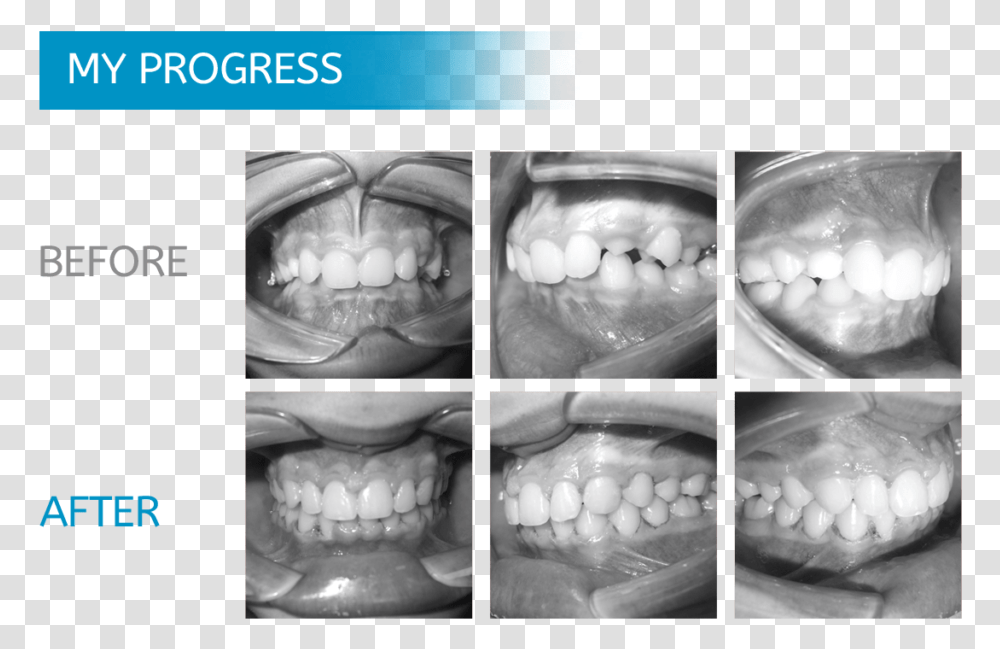 Midwest Orthodontics Chicago Teeth Xray Before And After Braces, Mouth, Lip, Jaw Transparent Png