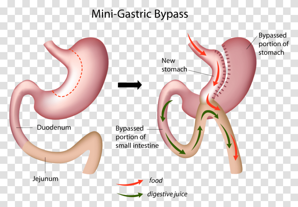 Mini Gastric Bypass, Stomach, Blow Dryer, Appliance, Label Transparent Png