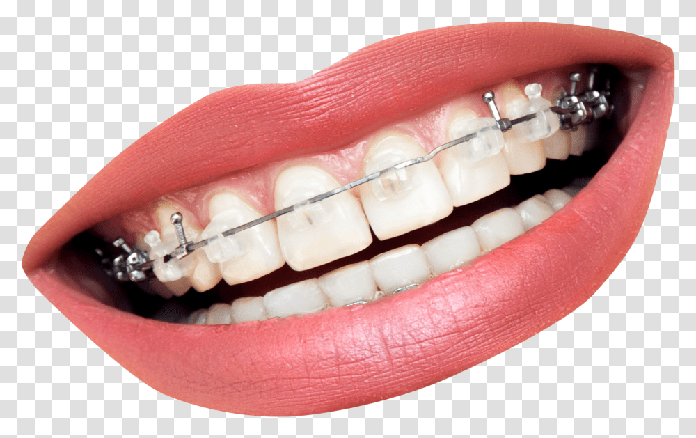 Mouth With Braces, Teeth, Lip, Person, Human Transparent Png