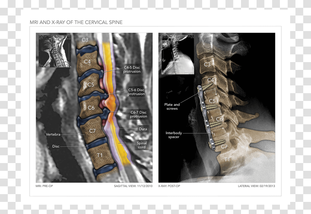 Mri And X Ray Of The Cervical Spine Medical Imaging, Building, Architecture Transparent Png
