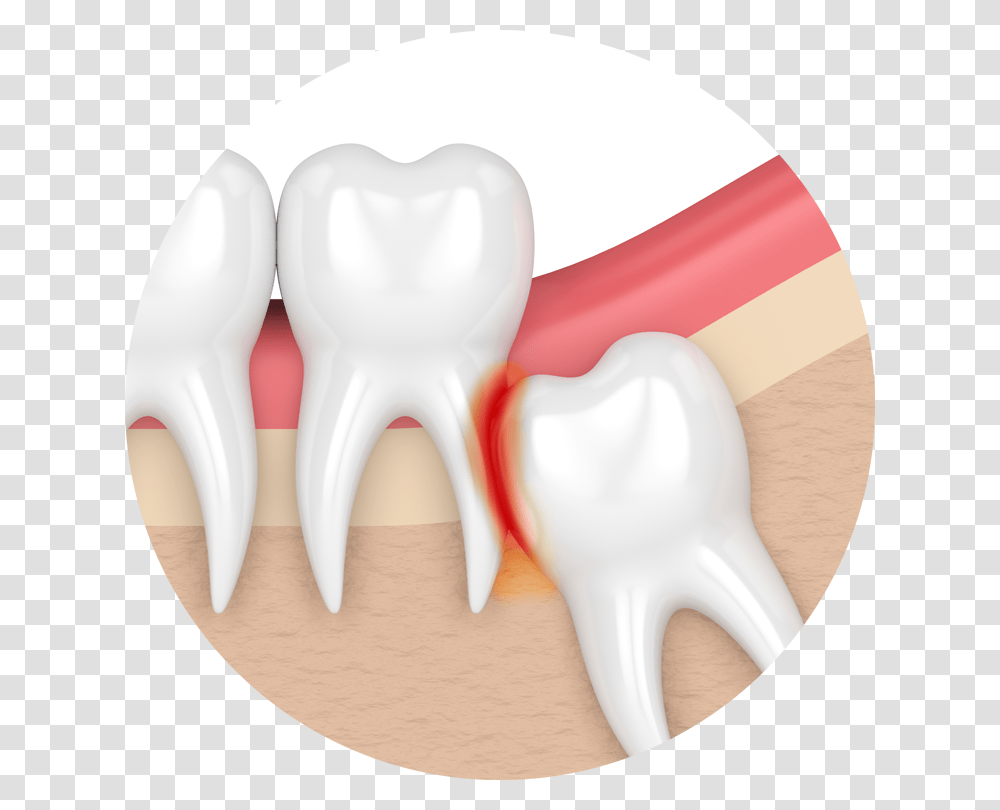 My Teeth Are Becoming Impaction Teeth Impacted Wisdom Tooth, Blow Dryer, Appliance, Hand, Shoulder Transparent Png