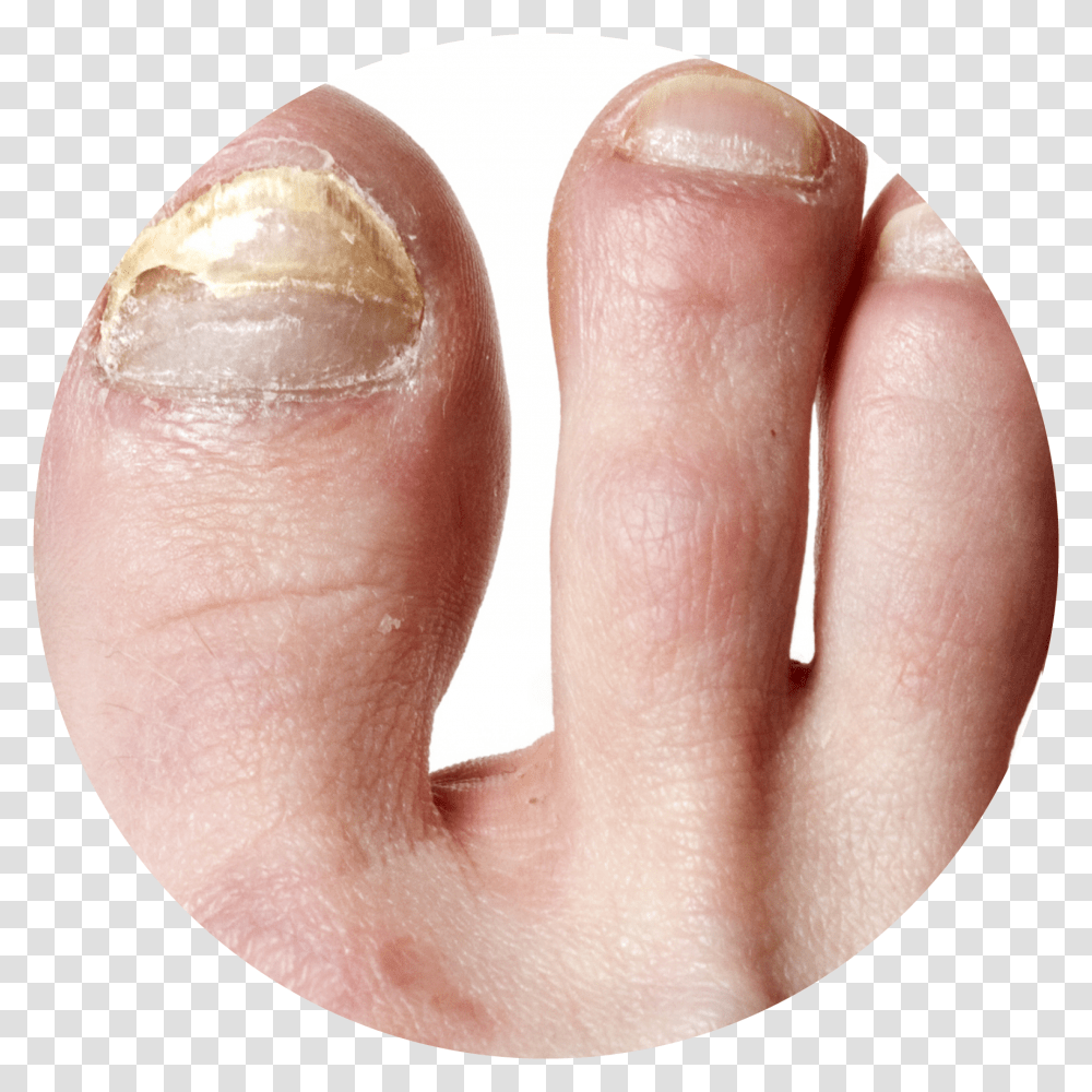 Nail Infection Circle Gribok Na Nogtyah Nog, Toe, Person, Human, Injury Transparent Png
