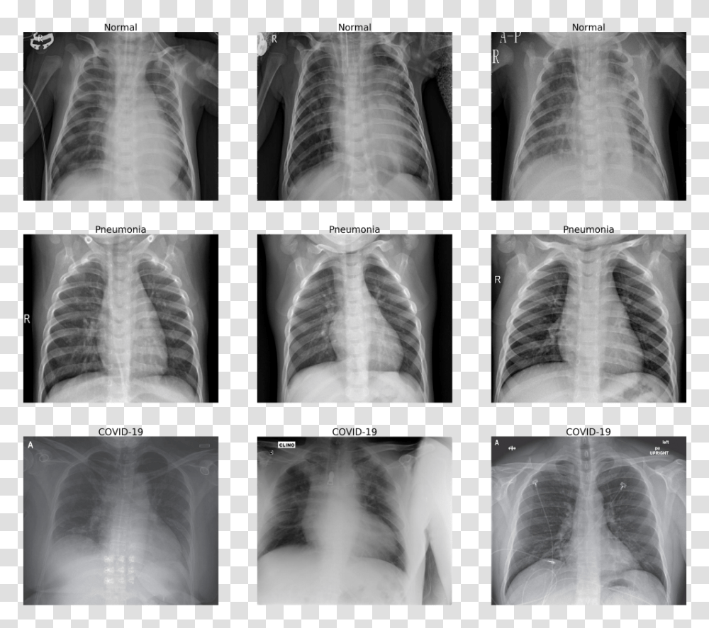 Normal Chest X Ray Vs Covid 19 Chest X Ray, X-Ray, Ct Scan, Medical Imaging X-Ray Film, Person Transparent Png