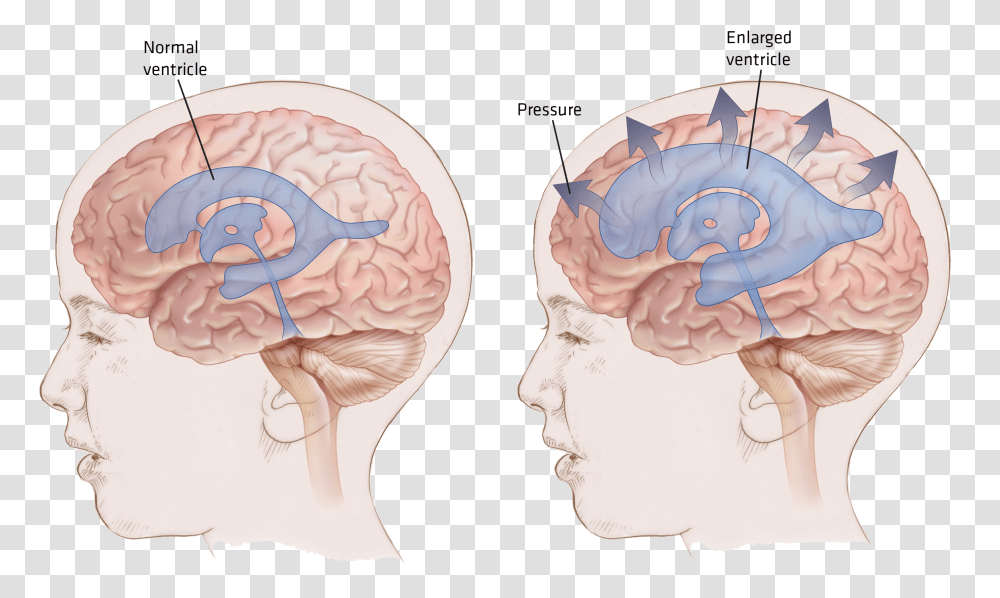 Null Hydrocephalus Brain, Ear Transparent Png