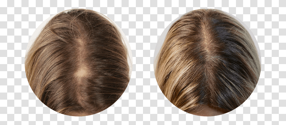 Nutrafol Before After, Hair, Hair Slide, Head, Face Transparent Png