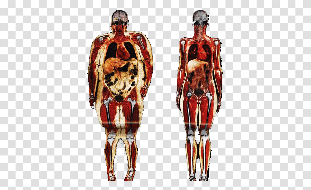 Obesity Human Body Adipose Tissue Anatomy Connective Fat Person Vs Skinny Person, Torso, Skeleton, Tattoo, Painting Transparent Png