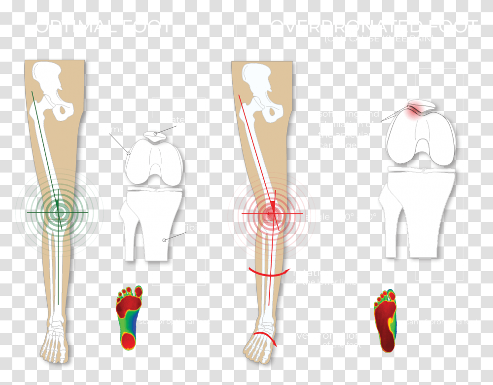 Optimal Foot Vs Over Pronated Foot And Knee Pain Pronation Foot, Plot, Diagram, Measurements, Hand Transparent Png