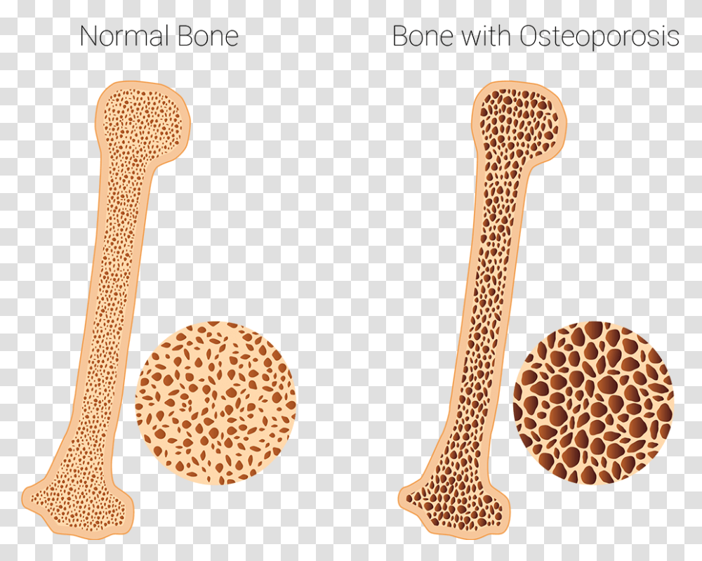 Osteoporosis Clinic Healthy And Osteoporotic Bone, Food, Sweets, Musical Instrument, Wheat Transparent Png