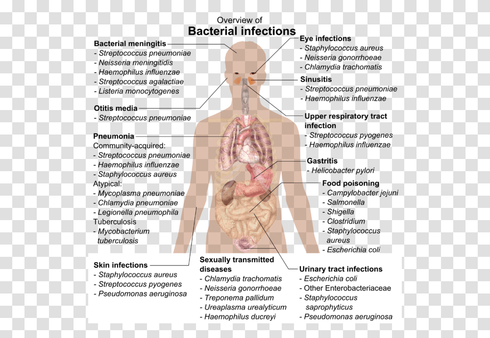 Overview Of Bacterial Infections, Person, Human, Torso, Poster Transparent Png
