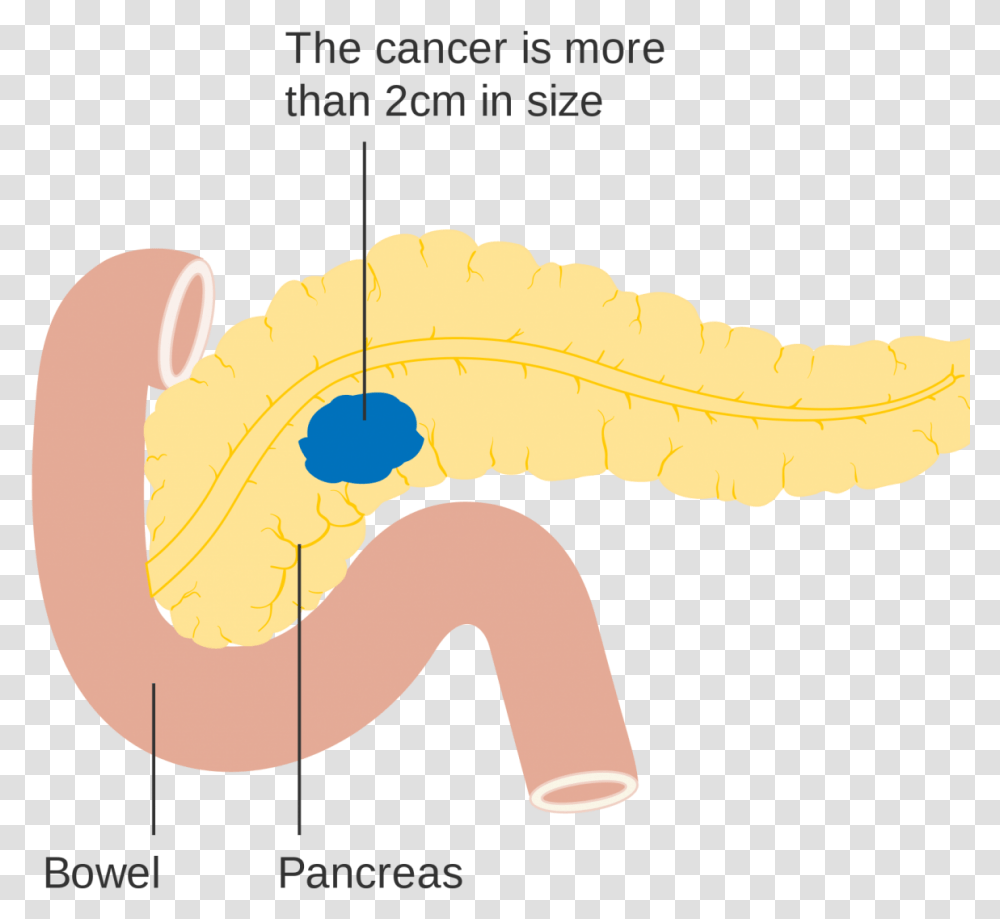 Pancreatic Cancer, Animal, Stomach, Fungus, Teeth Transparent Png