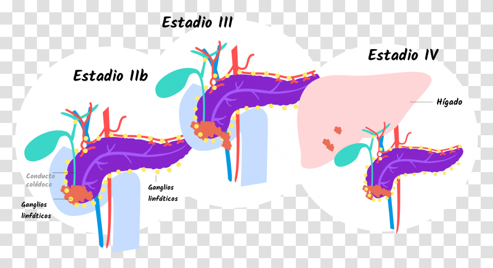 Pancreatic Cancer Stage 4 Tumor, Outdoors, Nature Transparent Png