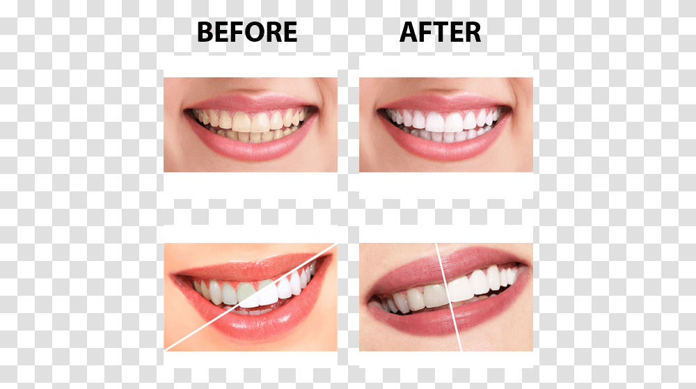 Parodontax Toothpaste Before And After, Teeth, Mouth, Lip, Person Transparent Png