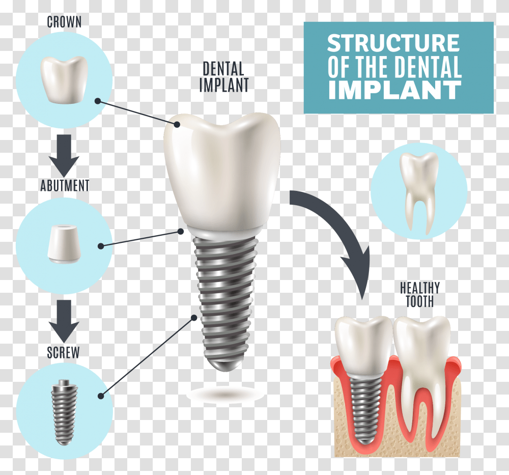 Part Of Dental Implant, Light, Lightbulb Transparent Png