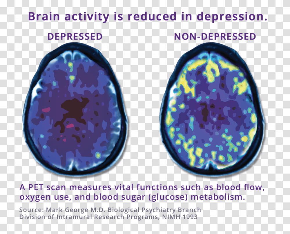 Pet Scan Comparing Depressed Brain To Non Depressed Tms Depression, Gemstone, Jewelry, Accessories, Accessory Transparent Png