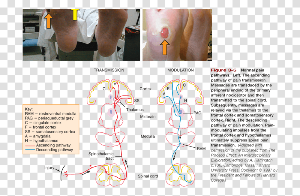 Photos Of Claw Toes Foot Deformity Green Arrow Diagram, Person, Human, Text, Flyer Transparent Png