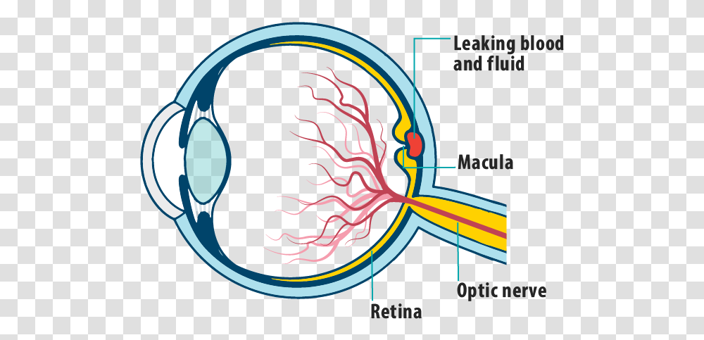 Picture Of Effects Of Wet Amd On The Eye Showing Leaking Eye Retinal Blood Vessel, Label, Poster, Advertisement Transparent Png