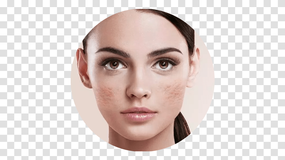 Pimple Acne Scar Removal Treatment In Ratio Of Beautiful Face, Person, Human, Head, Portrait Transparent Png